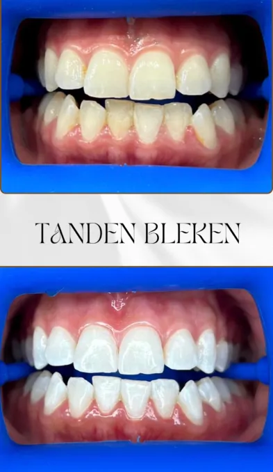 Tanden bleken